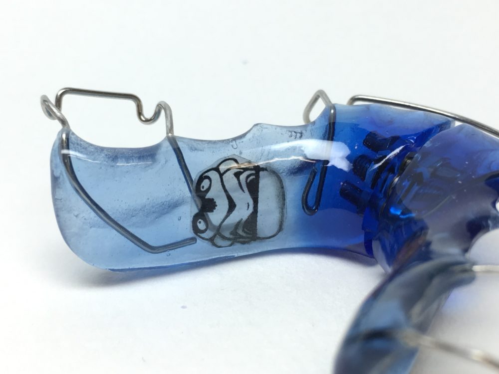 Detall d’un aparell d’ortodòncia blau elaborat al laboratori X&M