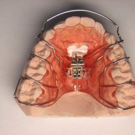 ortodonciabcn_removible_12